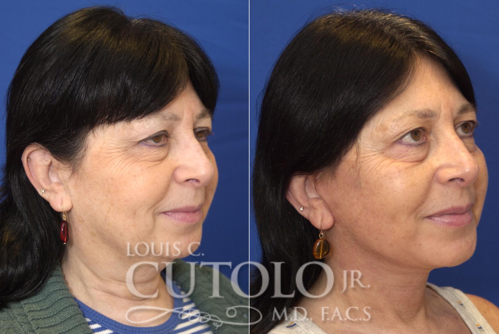 Before & After Rejuvelift™ - Mini Lift Case 81 View #4 View in Brooklyn, Staten Island, Queens, NY