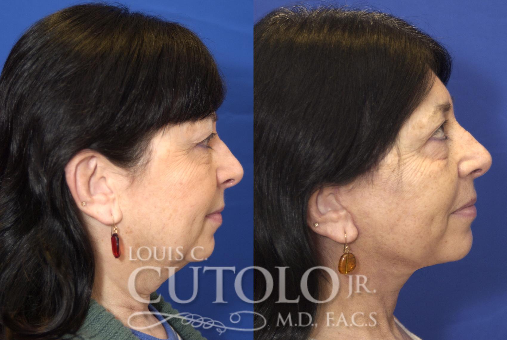 Before & After Rejuvelift™ - Mini Lift Case 81 View #5 View in Brooklyn, Staten Island, Queens, NY