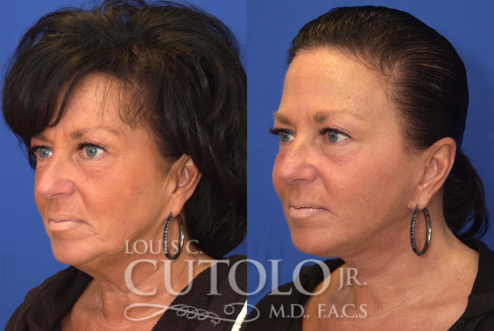 Before & After Rejuvelift™ - Mini Lift Case 90 View #2 View in Brooklyn, Staten Island, Queens, NY
