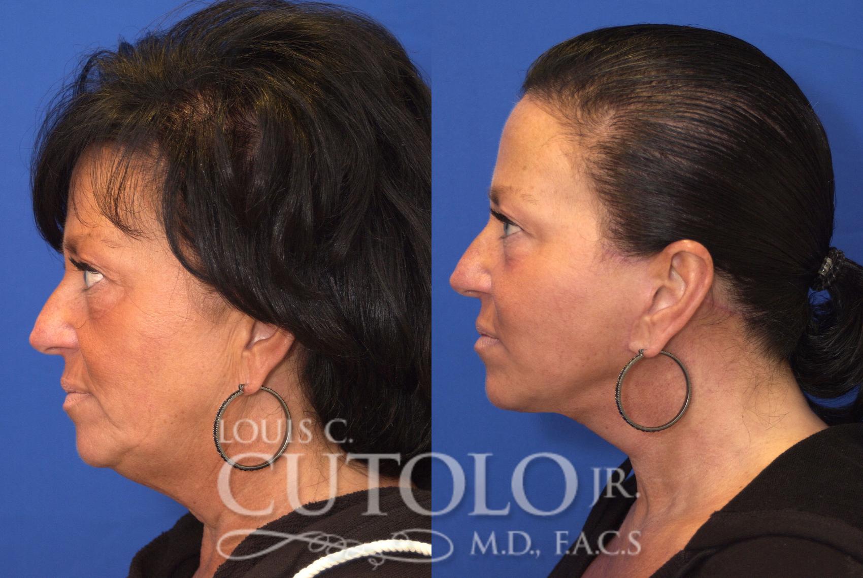 Before & After Rejuvelift™ - Mini Lift Case 90 View #3 View in Brooklyn, Staten Island, Queens, NY