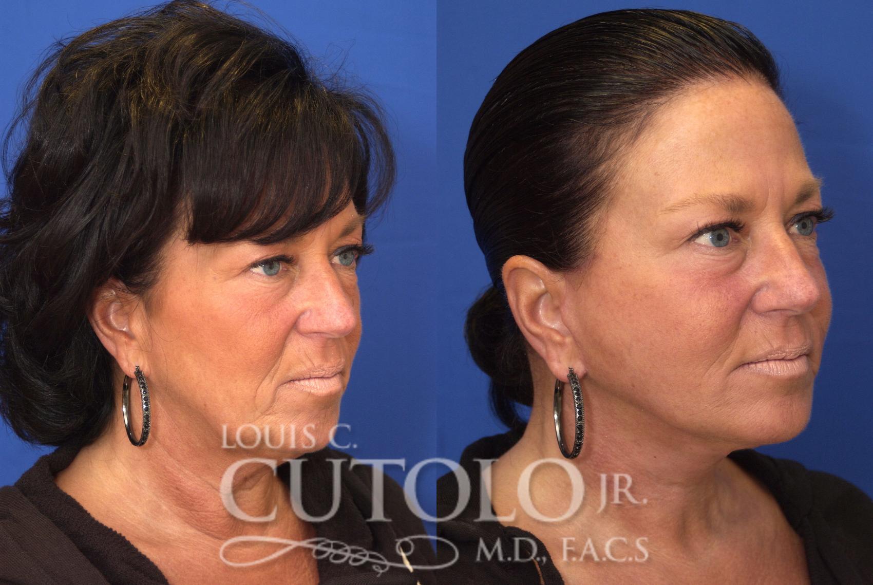 Before & After Rejuvelift™ - Mini Lift Case 90 View #4 View in Brooklyn, Staten Island, Queens, NY