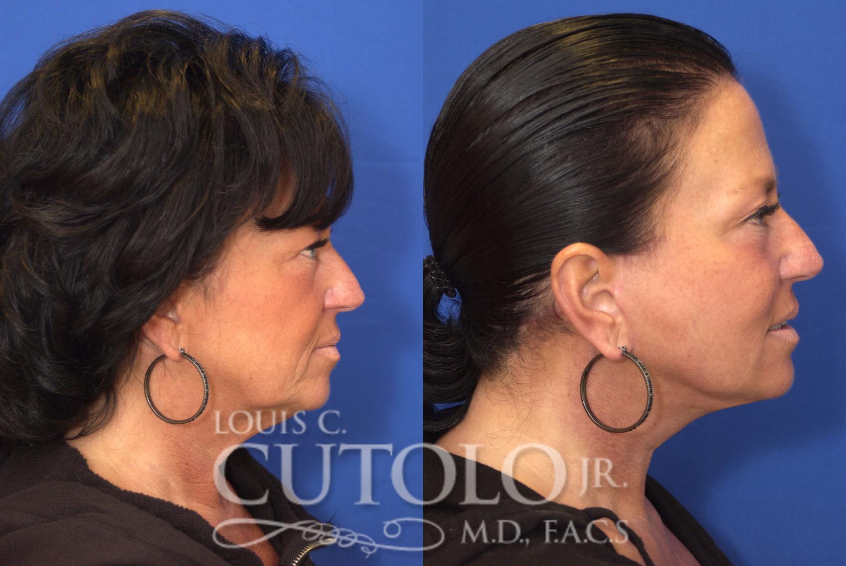 Before & After Rejuvelift™ - Mini Lift Case 90 View #5 View in Brooklyn, Staten Island, Queens, NY