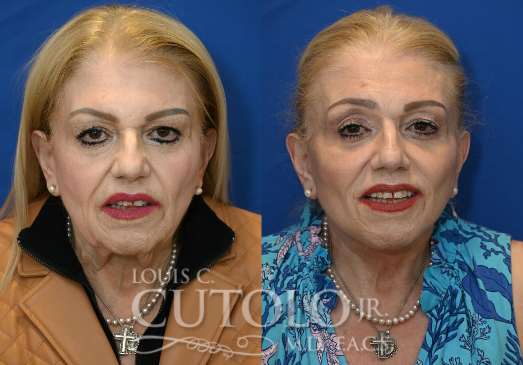 Anterior before