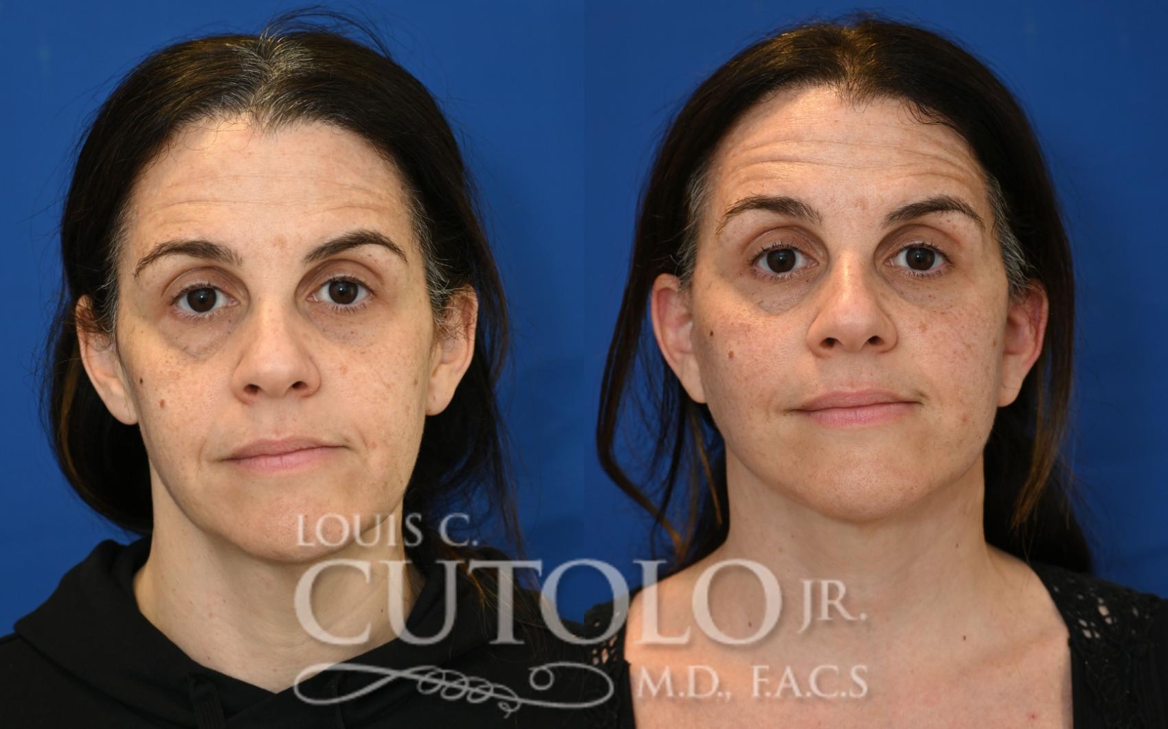 Anterior before