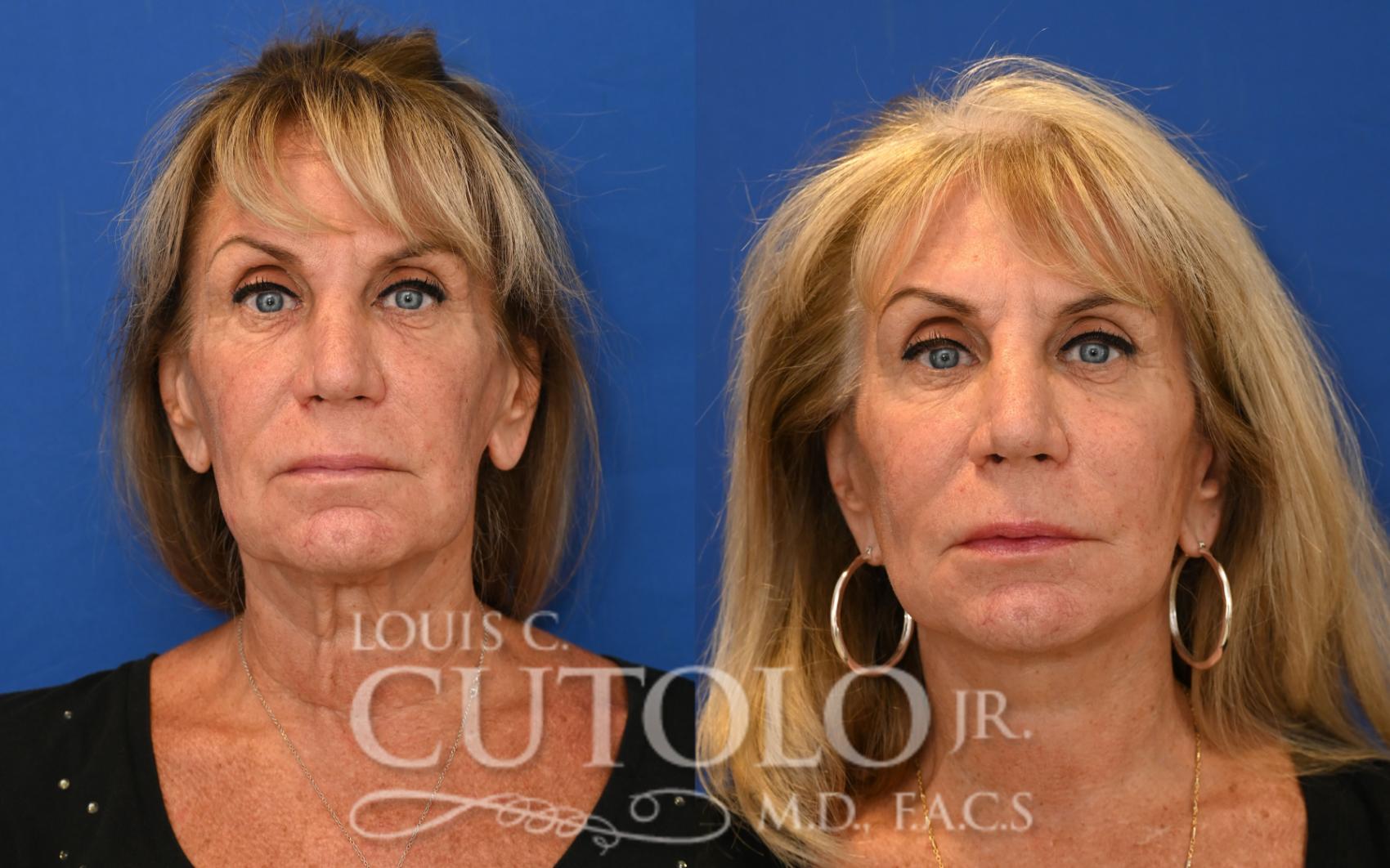 Anterior before
