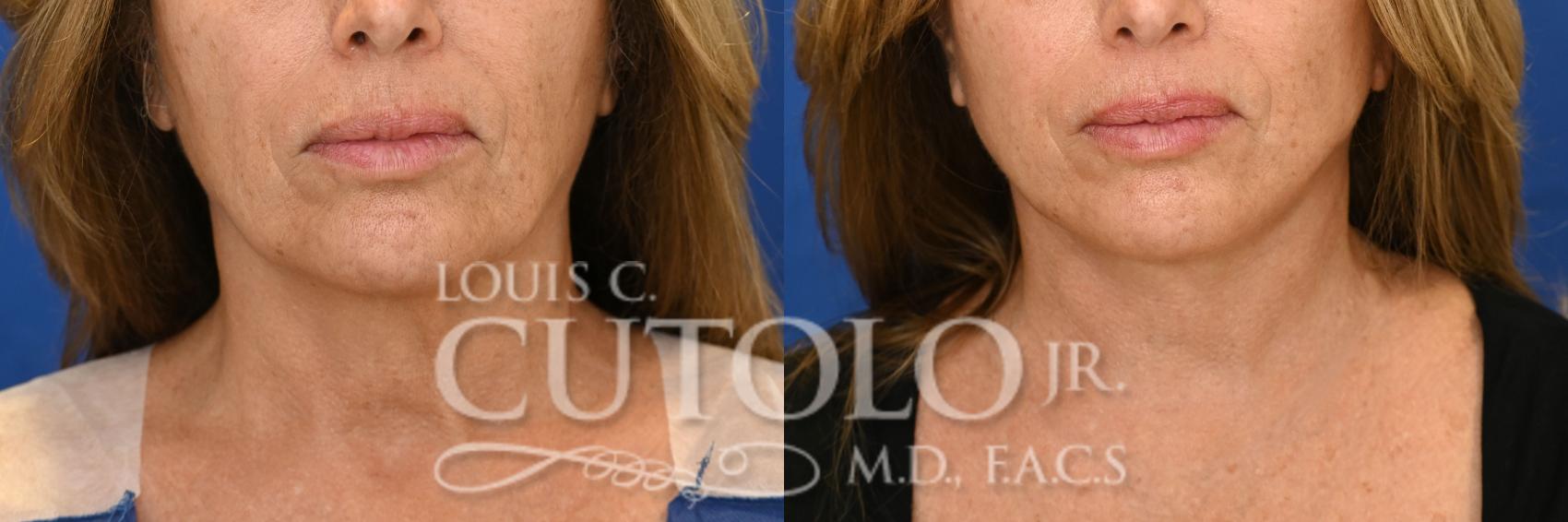 Anterior before