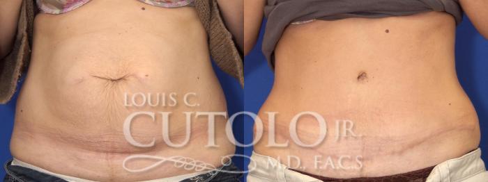 Before & After Tummy Tuck Case 1 View #1 View in Brooklyn, Staten Island, Queens, NY