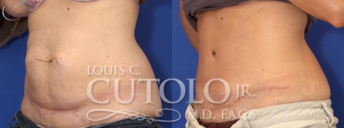 Before & After Tummy Tuck Case 1 View #2 View in Brooklyn, Staten Island, Queens, NY