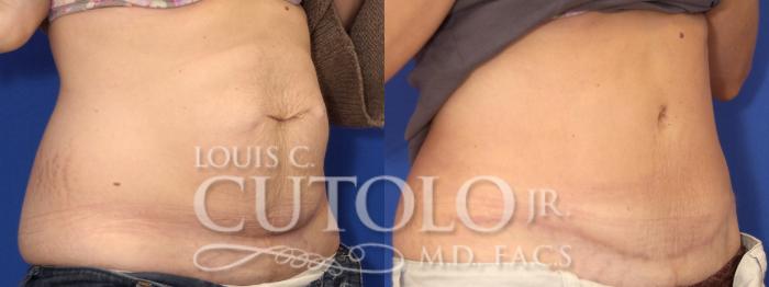 Before & After Tummy Tuck Case 1 View #3 View in Brooklyn, Staten Island, Queens, NY