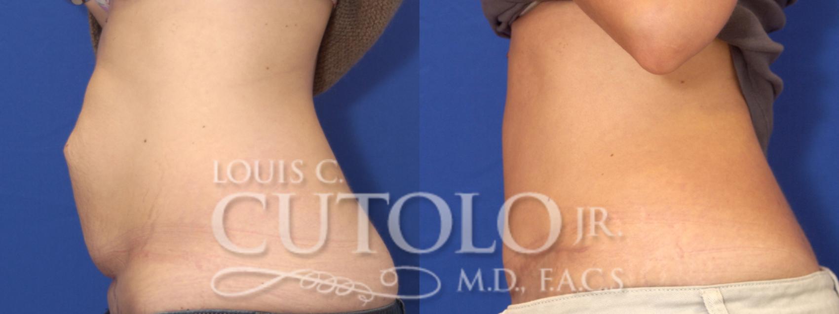 Before & After Tummy Tuck Case 1 View #4 View in Brooklyn, Staten Island, Queens, NY