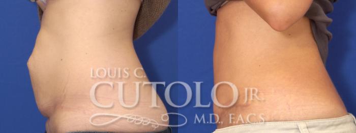 Before & After Tummy Tuck Case 1 View #4 View in Brooklyn, Staten Island, Queens, NY