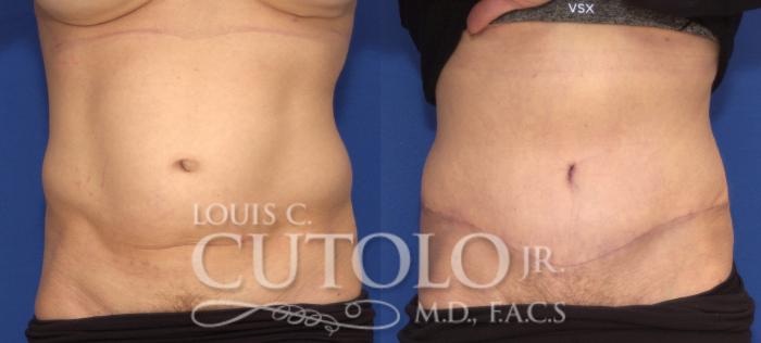 Before & After Tummy Tuck Case 103 View #1 View in Brooklyn, Staten Island, Queens, NY