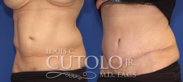 Before & After Tummy Tuck Case 103 View #2 View in Brooklyn, Staten Island, Queens, NY