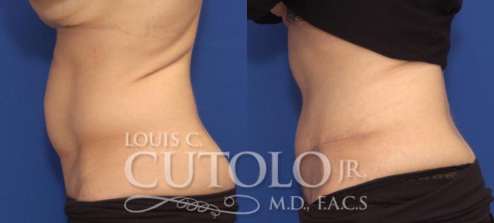 Before & After Tummy Tuck Case 103 View #3 View in Brooklyn, Staten Island, Queens, NY