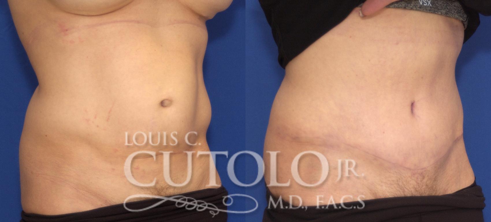 Before & After Tummy Tuck Case 103 View #4 View in Brooklyn, Staten Island, Queens, NY