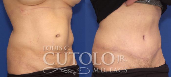 Before & After Tummy Tuck Case 103 View #4 View in Brooklyn, Staten Island, Queens, NY