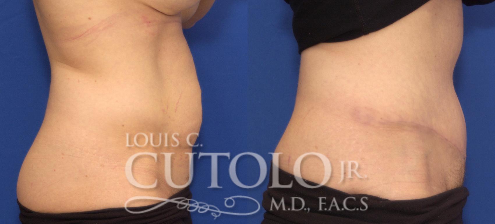 Before & After Tummy Tuck Case 103 View #5 View in Brooklyn, Staten Island, Queens, NY