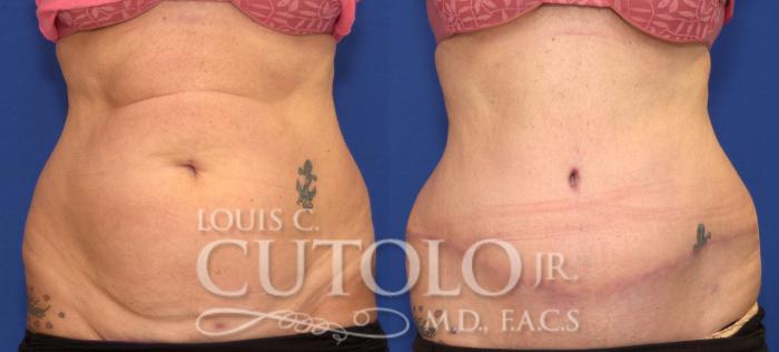 Before & After Tummy Tuck Case 104 View #1 View in Brooklyn, Staten Island, Queens, NY