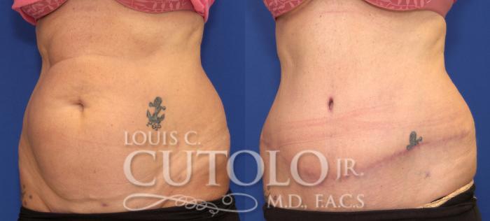 Before & After Tummy Tuck Case 104 View #2 View in Brooklyn, Staten Island, Queens, NY