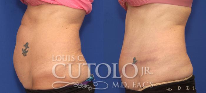 Before & After Tummy Tuck Case 104 View #3 View in Brooklyn, Staten Island, Queens, NY