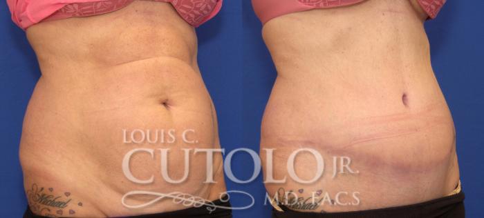 Before & After Tummy Tuck Case 104 View #4 View in Brooklyn, Staten Island, Queens, NY