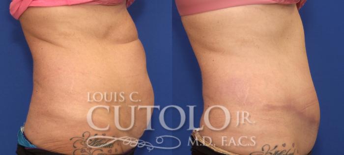 Before & After Tummy Tuck Case 104 View #5 View in Brooklyn, Staten Island, Queens, NY
