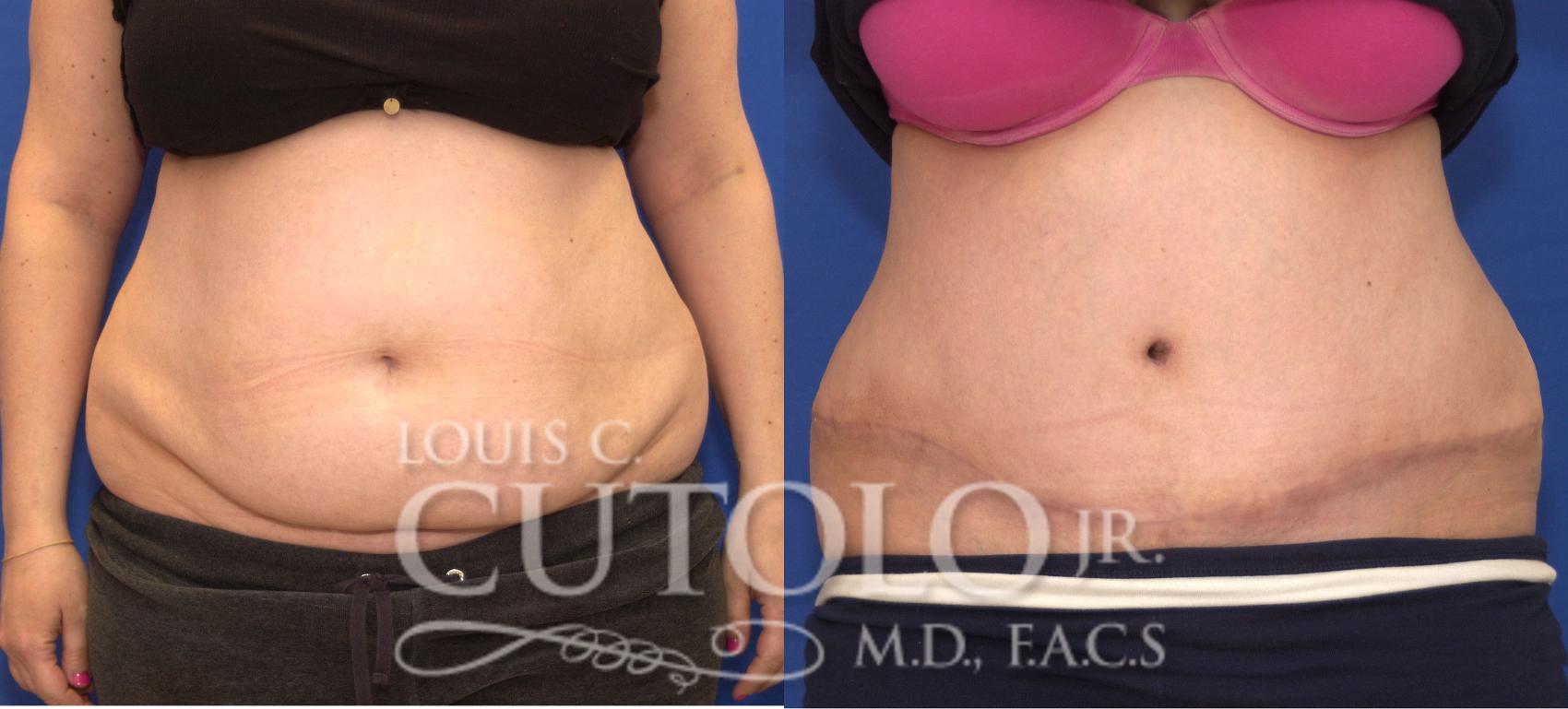 Before & After Tummy Tuck Case 110 View #1 View in Brooklyn, Staten Island, Queens, NY
