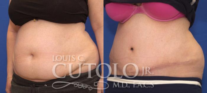 Before & After Tummy Tuck Case 110 View #2 View in Brooklyn, Staten Island, Queens, NY