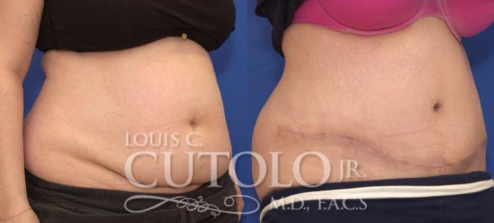 Before & After Tummy Tuck Case 110 View #4 View in Brooklyn, Staten Island, Queens, NY