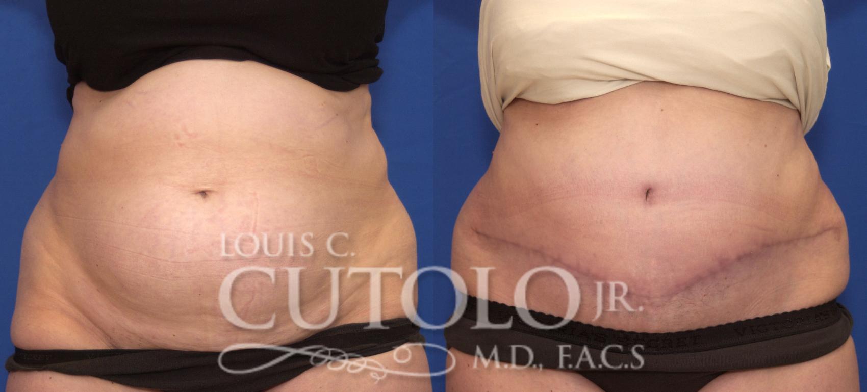Before & After Tummy Tuck Case 111 View #1 View in Brooklyn, Staten Island, Queens, NY