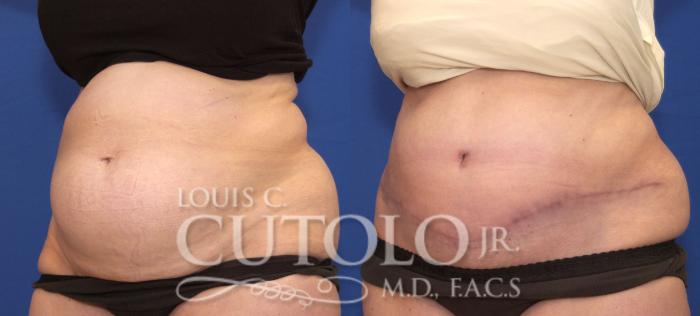 Before & After Tummy Tuck Case 111 View #2 View in Brooklyn, Staten Island, Queens, NY