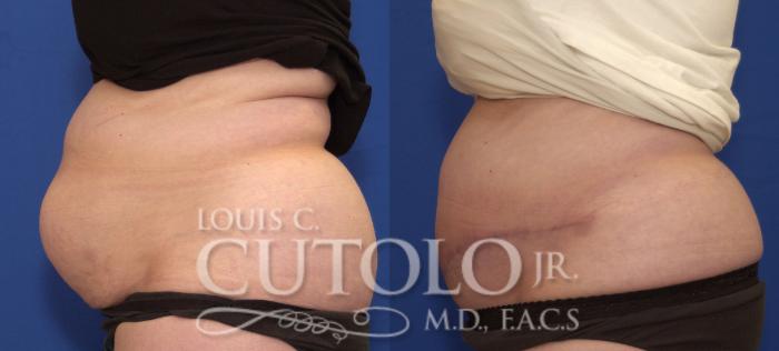Before & After Tummy Tuck Case 111 View #3 View in Brooklyn, Staten Island, Queens, NY