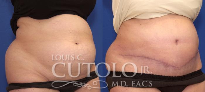 Before & After Tummy Tuck Case 111 View #4 View in Brooklyn, Staten Island, Queens, NY