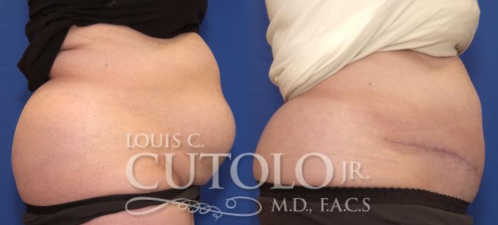 Before & After Tummy Tuck Case 111 View #5 View in Brooklyn, Staten Island, Queens, NY