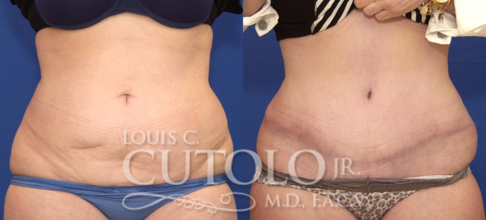 Before & After Tummy Tuck Case 115 View #1 View in Brooklyn, Staten Island, Queens, NY