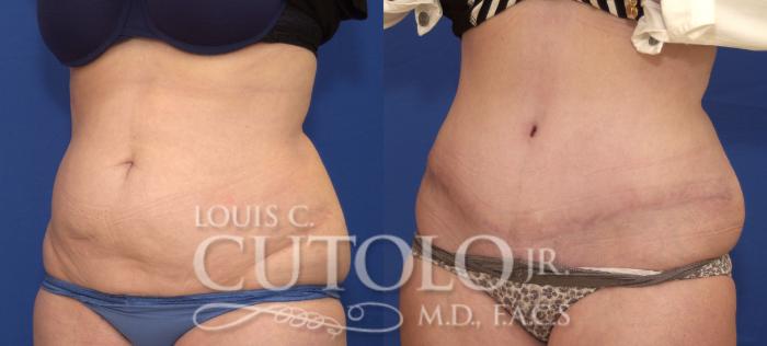 Before & After Tummy Tuck Case 115 View #2 View in Brooklyn, Staten Island, Queens, NY