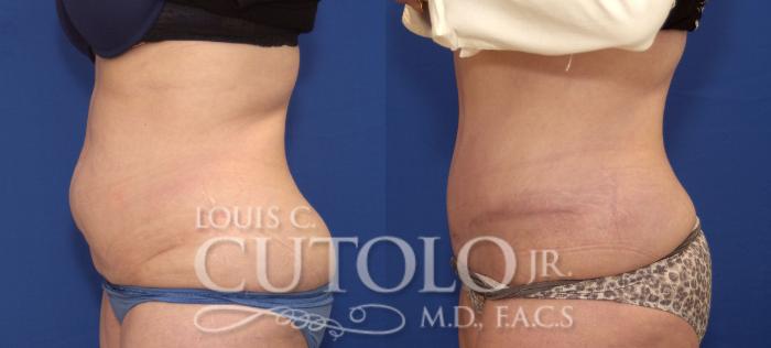 Before & After Tummy Tuck Case 115 View #3 View in Brooklyn, Staten Island, Queens, NY