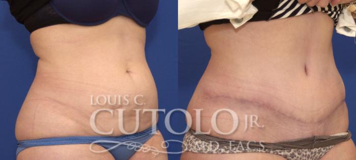 Before & After Tummy Tuck Case 115 View #4 View in Brooklyn, Staten Island, Queens, NY