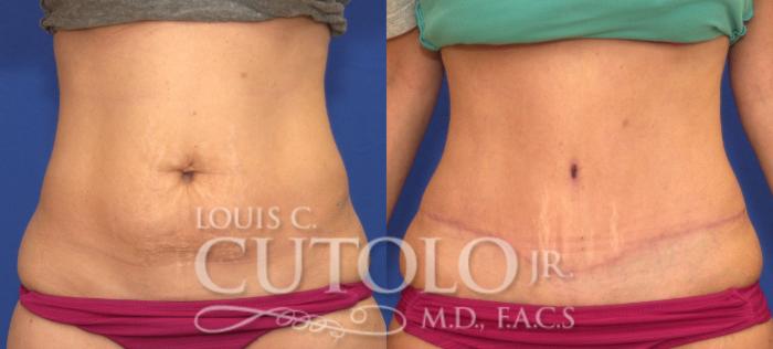 Before & After Tummy Tuck Case 117 View #1 View in Brooklyn, Staten Island, Queens, NY