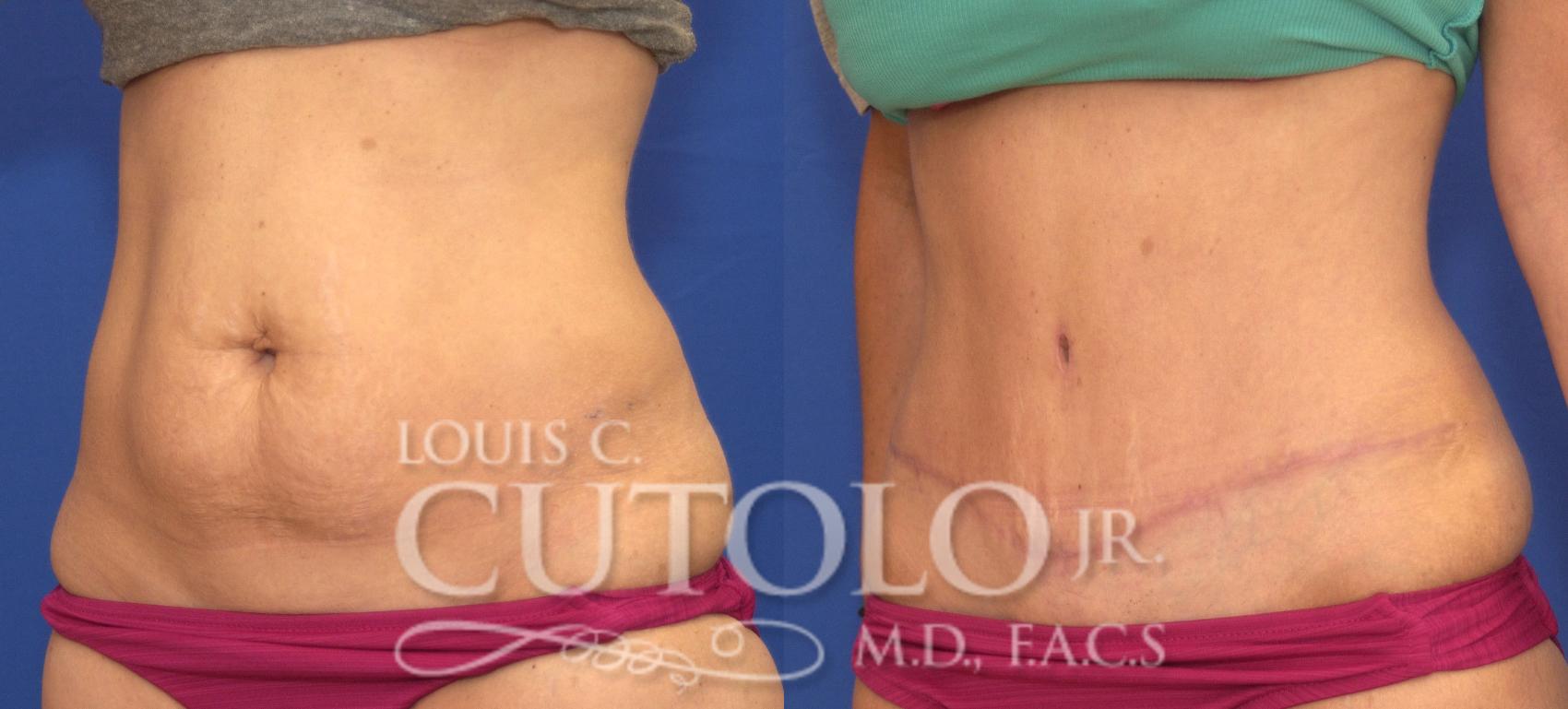Before & After Tummy Tuck Case 117 View #2 View in Brooklyn, Staten Island, Queens, NY
