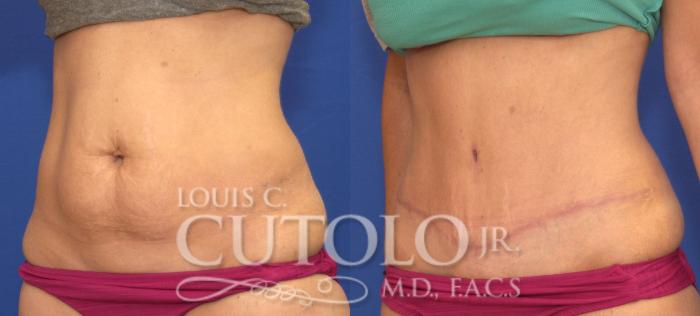 Before & After Tummy Tuck Case 117 View #2 View in Brooklyn, Staten Island, Queens, NY