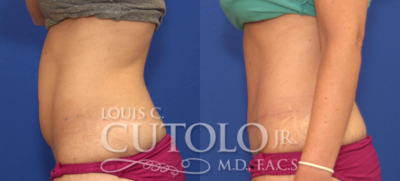Before & After Tummy Tuck Case 117 View #3 View in Brooklyn, Staten Island, Queens, NY