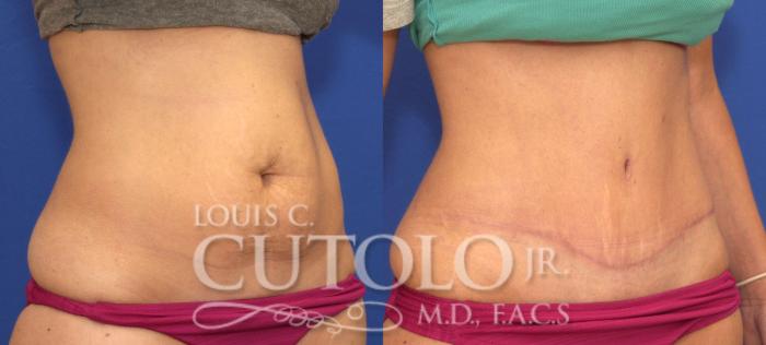 Before & After Tummy Tuck Case 117 View #4 View in Brooklyn, Staten Island, Queens, NY