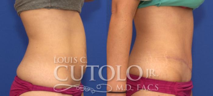 Before & After Tummy Tuck Case 117 View #5 View in Brooklyn, Staten Island, Queens, NY
