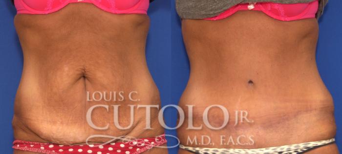 Before & After Tummy Tuck Case 121 View #1 View in Brooklyn, Staten Island, Queens, NY