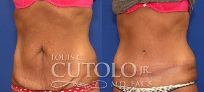Before & After Tummy Tuck Case 121 View #2 View in Brooklyn, Staten Island, Queens, NY