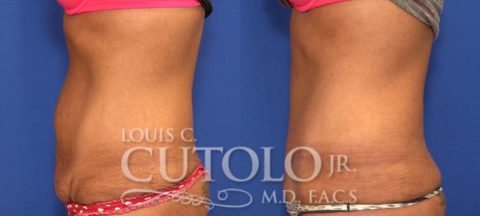Before & After Tummy Tuck Case 121 View #3 View in Brooklyn, Staten Island, Queens, NY