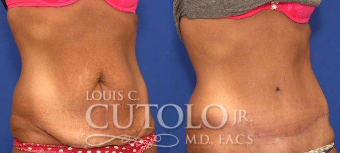 Before & After Tummy Tuck Case 121 View #4 View in Brooklyn, Staten Island, Queens, NY