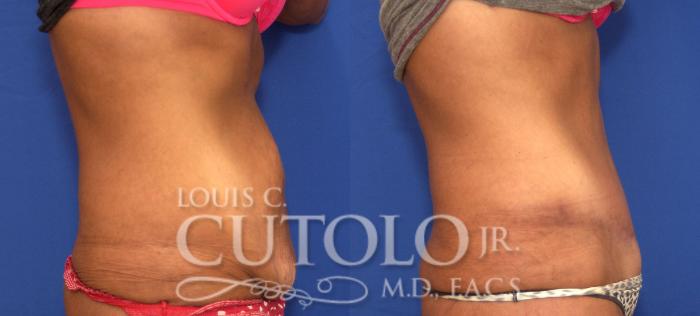 Before & After Tummy Tuck Case 121 View #5 View in Brooklyn, Staten Island, Queens, NY