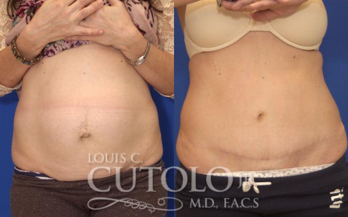 Before & After Tummy Tuck Case 143 View #1 View in Brooklyn, Staten Island, Queens, NY